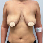 Редукционная маммопластика с подтяжкой без имплантации - до