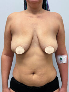 Редукционная маммопластика с подтяжкой без имплантации - до