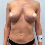 Реэндопротезирование - до