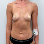 Маммопластика увеличение - до