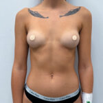 Маммопластика увеличение - до