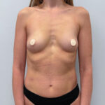 Маммопластика увеличение - до