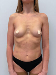 Маммопластика увеличение - до