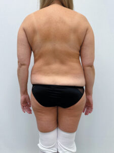 Липосакция - до