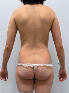 Бодилифт с липомоделированием - до