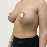 Увеличение груди с якорной подтяжкой - после