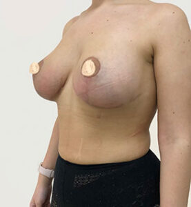 Увеличение груди с якорной подтяжкой - после