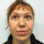 Круговая блефаропластика - после