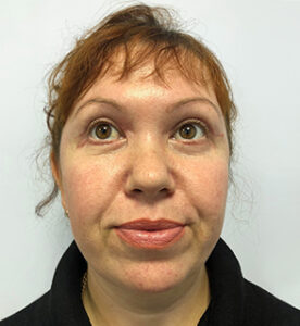 Круговая блефаропластика - после