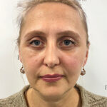 Круговая блефаропластика - после