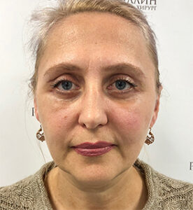 Круговая блефаропластика - после