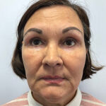 Круговая блефаропластика - после