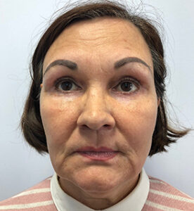 Круговая блефаропластика - после