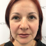 Круговая блефаропластика - после