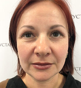 Круговая блефаропластика - после