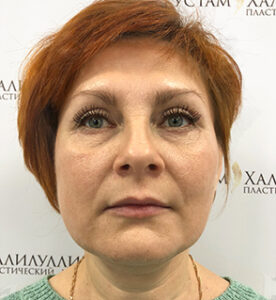 Круговая блефаропластика - после