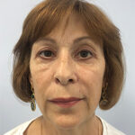 Круговая блефаропластика - после