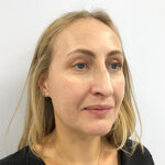 Круговая блефаропластика - после