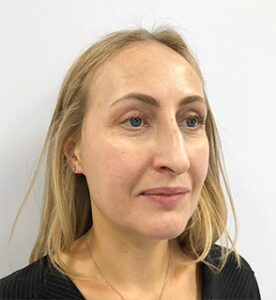 Круговая блефаропластика - после