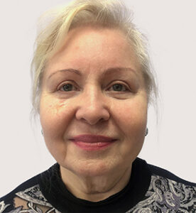 Круговая блефаропластика - после