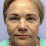 Круговая блефаропластика - после