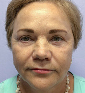 Круговая блефаропластика - после