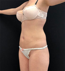 Липосакция - после