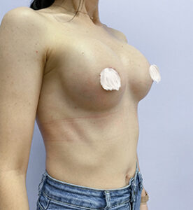 Увеличение груди - после