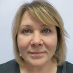 Круговая блефаропластика - после