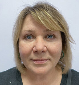 Круговая блефаропластика - после