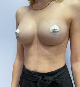 Маммопластика увеличение - после