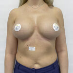 Реэндопротезирование груди - после