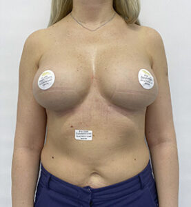 Реэндопротезирование груди - после