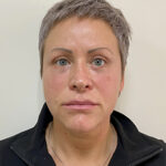 Круговая блефаропластика - после