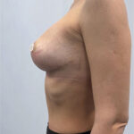 Реэндопротезирование - после