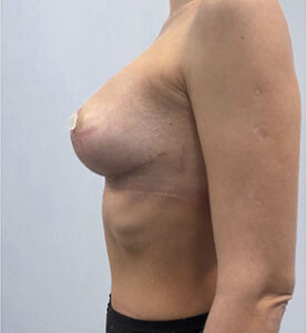 Реэндопротезирование - после