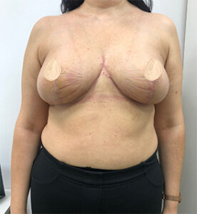 Коррекция асимметрии груди - после