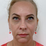 Нижняя блефаропластика - после