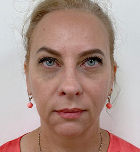 Нижняя блефаропластика - после