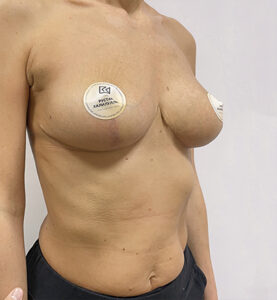 Уменьшение груди - после