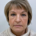 Круговая блефаропластика - после