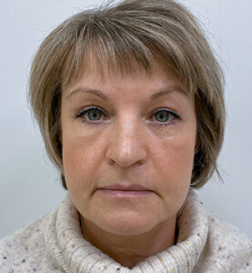 Круговая блефаропластика - после