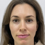 Круговая блефаропластика - после