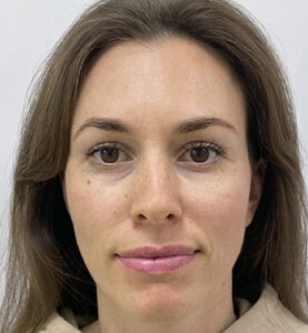 Круговая блефаропластика - после