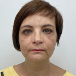 Круговая блефаропластика - после