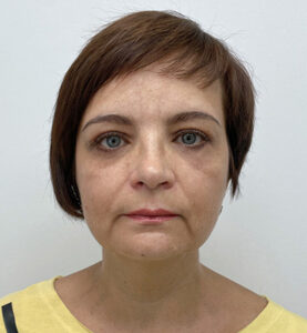 Круговая блефаропластика - после