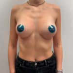 Маммопластика увеличение - после