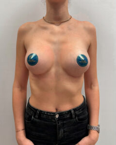 Маммопластика увеличение - после