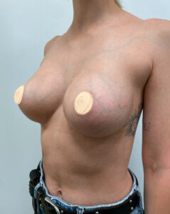 Маммопластика увеличение - после