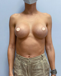 Маммопластика увеличение - после